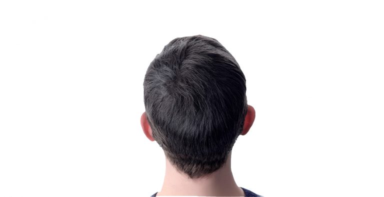 Cabelo masculino preto calvice, depois do produto Instant Hair Plus.