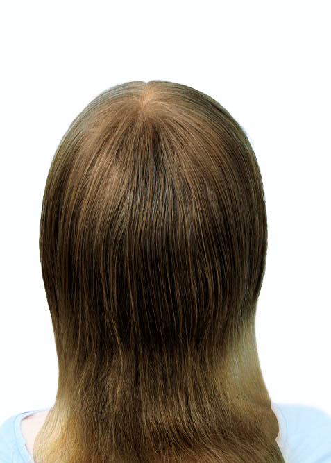 Comparativo calvice feminina cabelo castanho, depois do uso do instant hair plus.