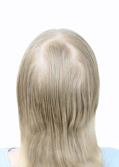 Comparativo calvice feminina cabelo loiro, antes do uso do instant hair plus.